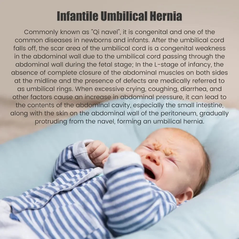 Infantile umbilical hernia information text